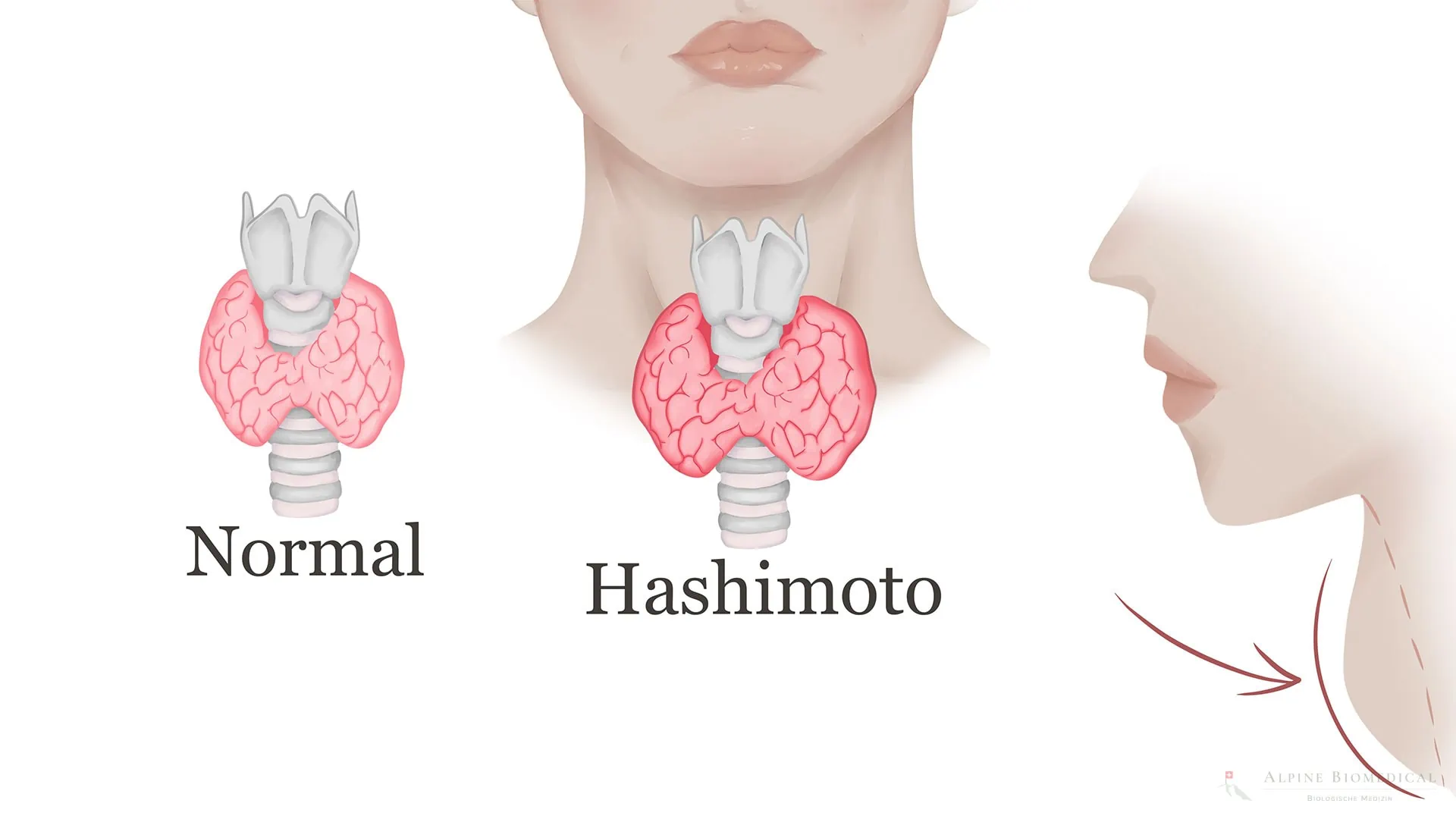 Hashimato