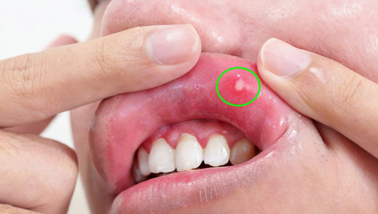 5 belirgin B vitamini eksikliği belirtisi