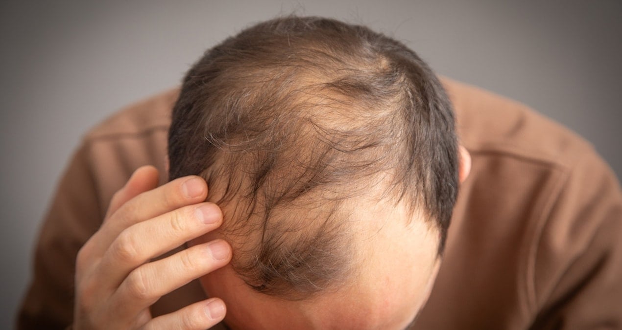 Erkeklerde kelliğe neden olan içecekler açıklandı