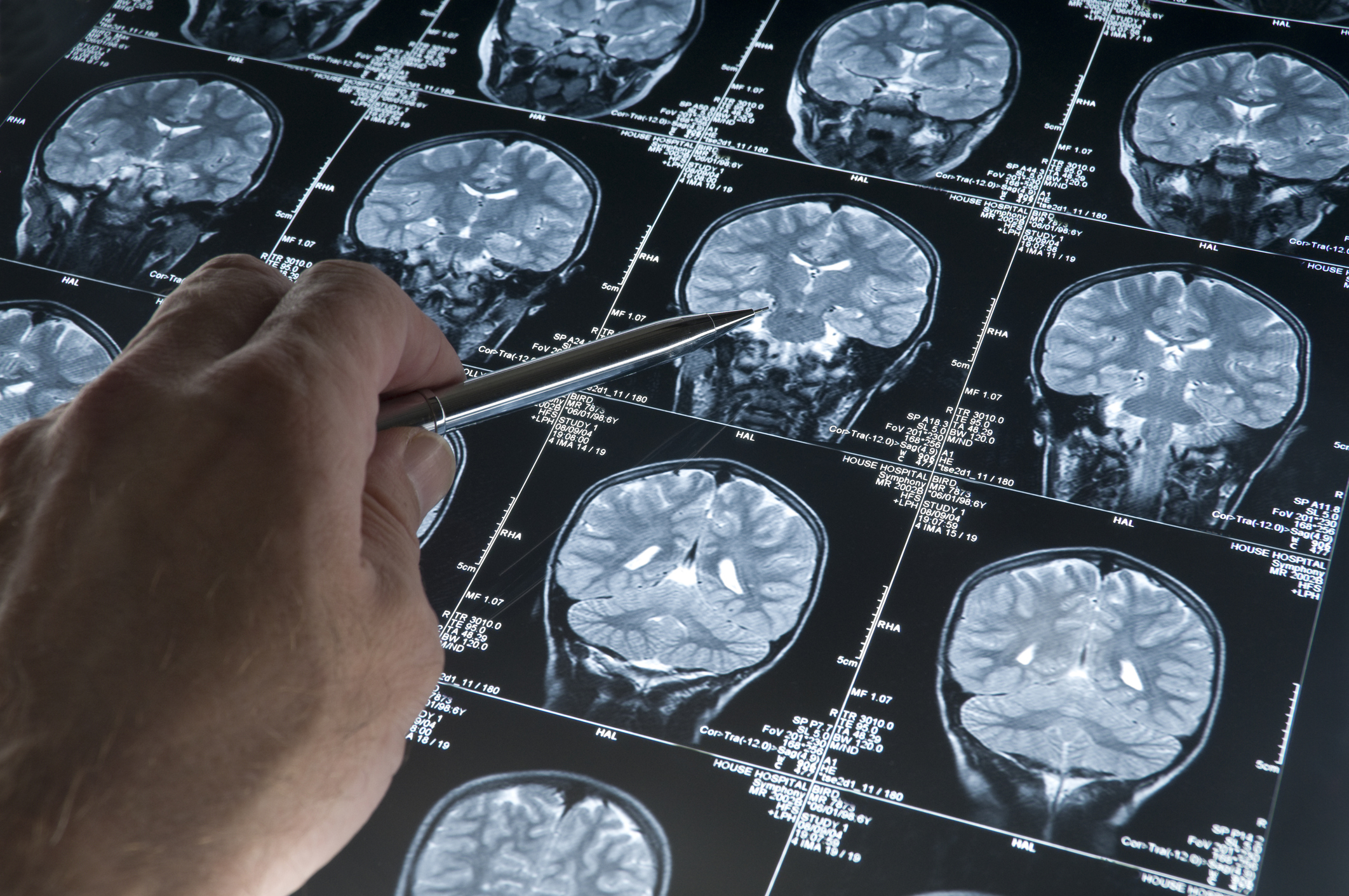 Alzheimer’da gençlik proteini keşfi